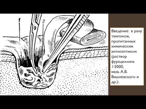 Введение в рану тампонов, пропитанных химическим антисептиком (раствор фурациллина 1:5000, мазь А.В. Вишневского и др.);
