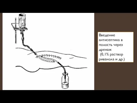 Введение антисептика в полость через дренаж (0,1% раствор риванола и др.)