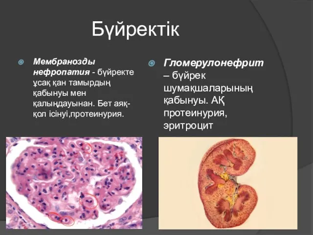 Бүйректік Мембранозды нефропатия - бүйректе ұсақ қан тамырдың қабынуы мен қалыңдауынан. Бет