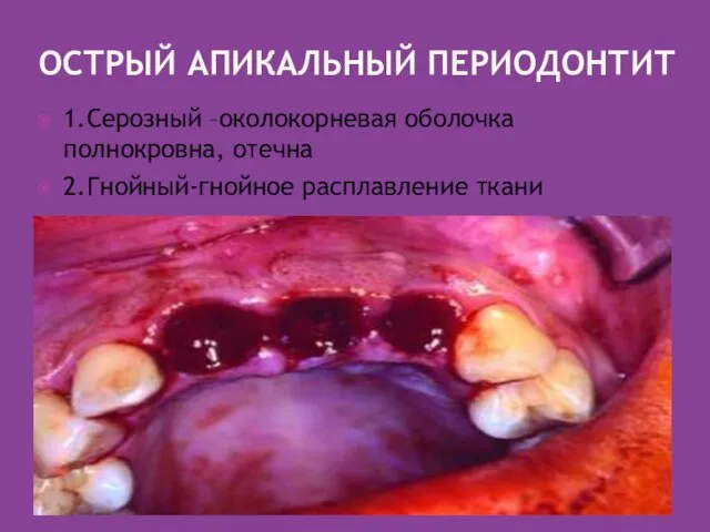 ОСТРЫЙ АПИКАЛЬНЫЙ ПЕРИОДОНТИТ 1.Серозный –околокорневая оболочка полнокровна, отечна 2.Гнойный-гнойное расплавление ткани