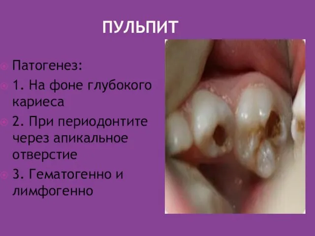 ПУЛЬПИТ Патогенез: 1. На фоне глубокого кариеса 2. При периодонтите через апикальное
