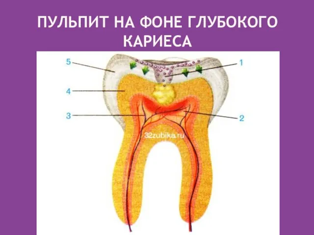 ПУЛЬПИТ НА ФОНЕ ГЛУБОКОГО КАРИЕСА