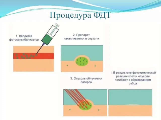 Процедура ФДТ