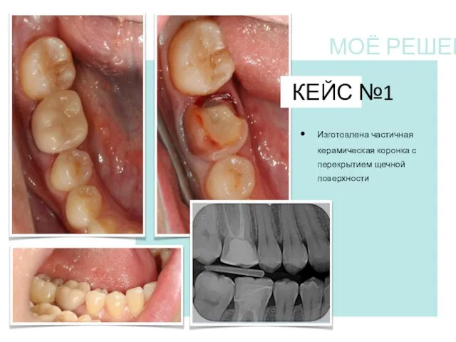 КЕЙС №1 Изготовлена частичная керамическая коронка с перекрытием щечной поверхности МОЁ РЕШЕНИЕ