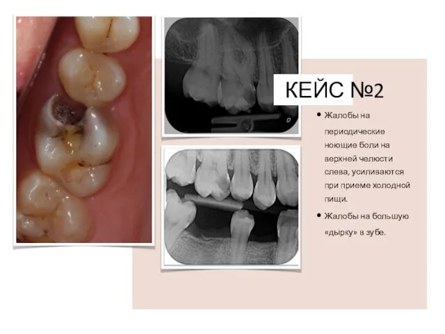 КЕЙС №2 Жалобы на периодические ноющие боли на верхней челюсти слева, усиливаются