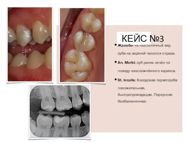 КЕЙС №3 Жалобы на неэстетичный вид зуба на верхней челюсти справа. An.