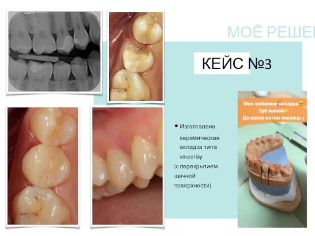 КЕЙС №3 Изготовлена керамическая вкладка типа vineerlay (c перекрытием щечной поверхности) МОЁ РЕШЕНИЕ