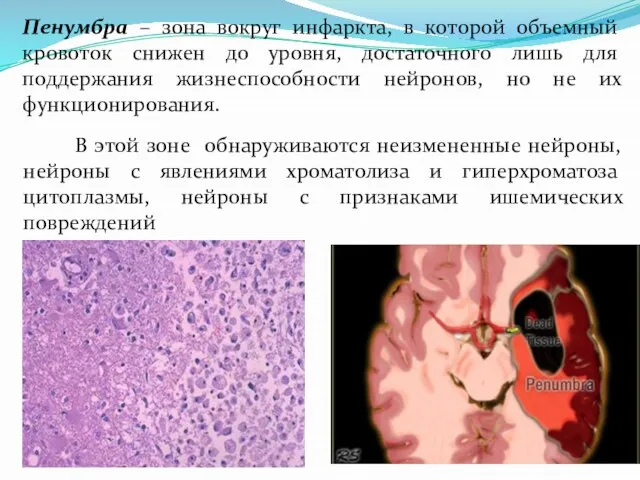 Пенумбра – зона вокруг инфаркта, в которой объемный кровоток снижен до уровня,