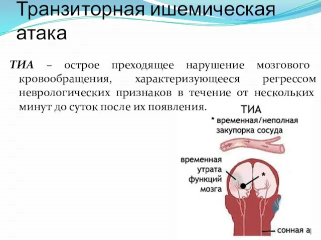 Транзиторная ишемическая атака ТИА – острое преходящее нарушение мозгового кровообращения, характеризующееся регрессом