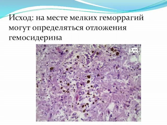 Исход: на месте мелких геморрагий могут определяться отложения гемосидерина