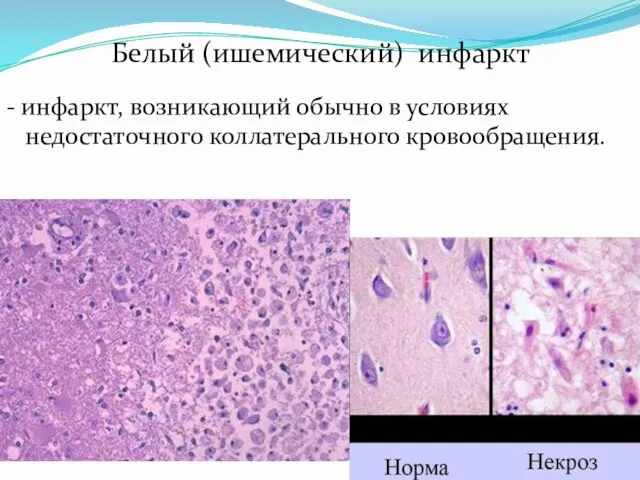 Белый (ишемический) инфаркт - инфаркт, возникающий обычно в условиях недостаточного коллатерального кровообращения.