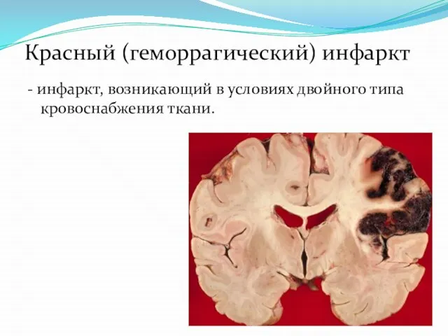 Красный (геморрагический) инфаркт - инфаркт, возникающий в условиях двойного типа кровоснабжения ткани.