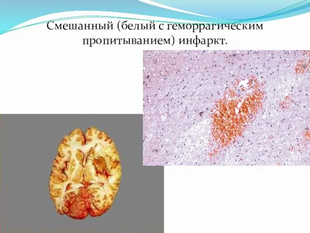 Смешанный (белый с геморрагическим пропитыванием) инфаркт.