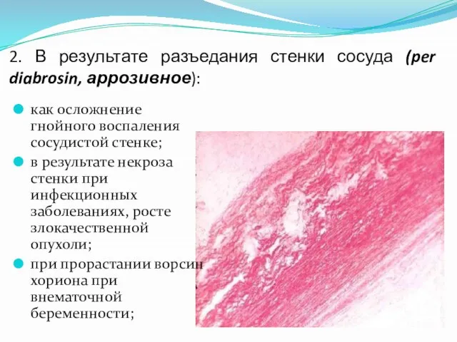 2. В результате разъедания стенки сосуда (per diabrosin, аррозивное): как осложнение гнойного