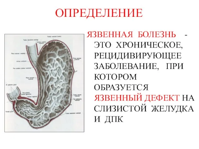 ОПРЕДЕЛЕНИЕ ЯЗВЕННАЯ БОЛЕЗНЬ - ЭТО ХРОНИЧЕСКОЕ, РЕЦИДИВИРУЮЩЕЕ ЗАБОЛЕВАНИЕ, ПРИ КОТОРОМ ОБРАЗУЕТСЯ ЯЗВЕННЫЙ