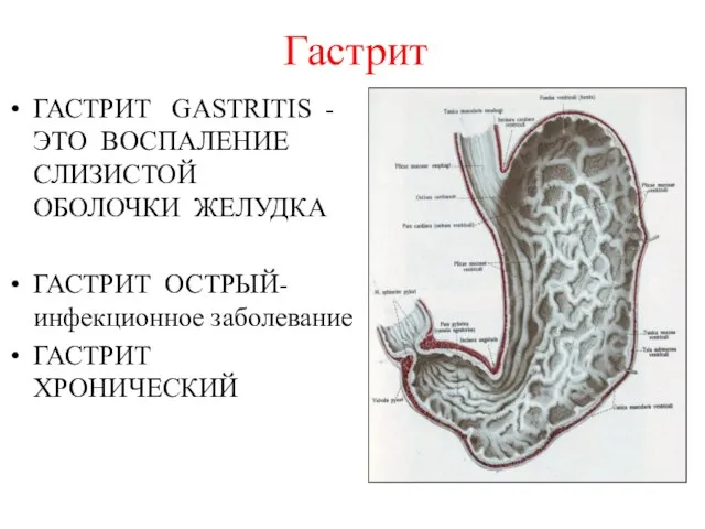 Гастрит ГАСТРИТ GASTRITIS - ЭТО ВОСПАЛЕНИЕ СЛИЗИСТОЙ ОБОЛОЧКИ ЖЕЛУДКА ГАСТРИТ ОСТРЫЙ-инфекционное заболевание ГАСТРИТ ХРОНИЧЕСКИЙ