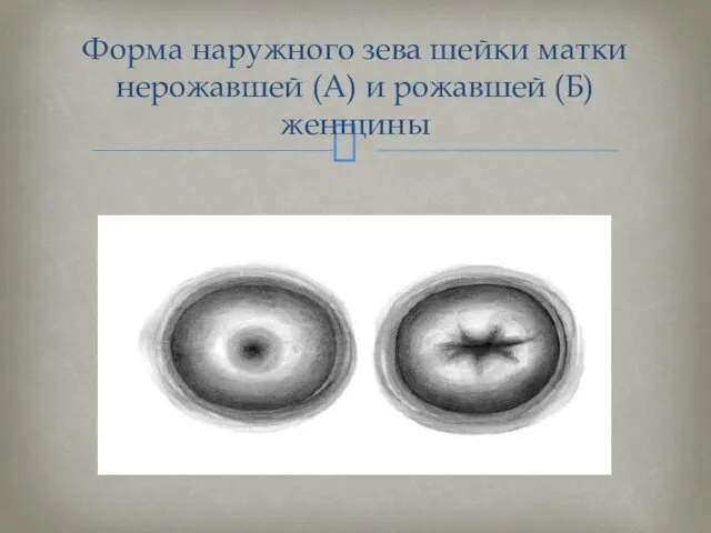 Форма наружного зева шейки матки нерожавшей (А) и рожавшей (Б) женщины