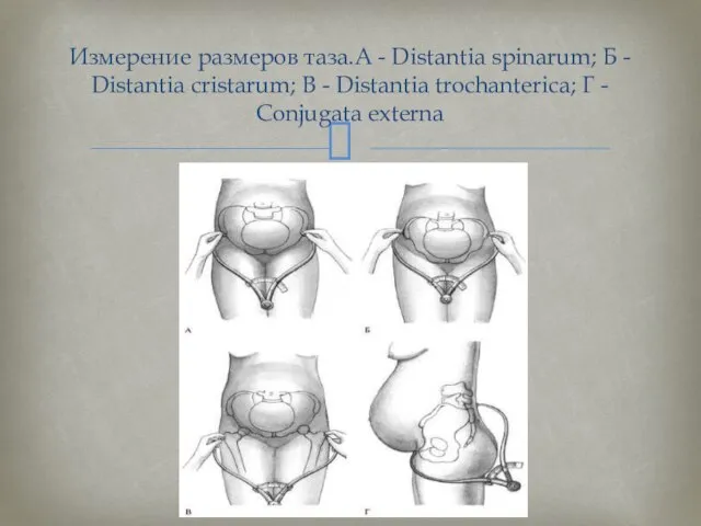 Измерение размеров таза.А - Distantia spinarum; Б - Distantia cristarum; В -