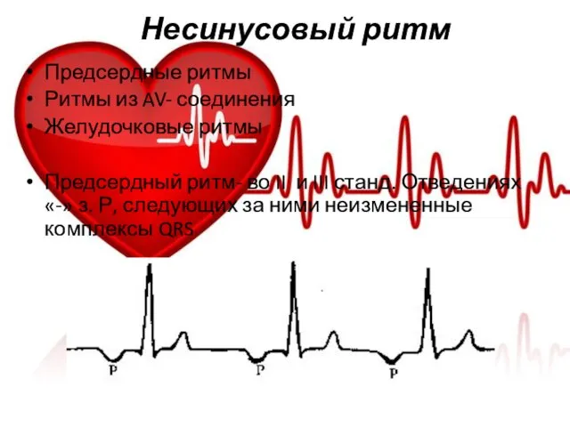 Несинусовый ритм Предсердные ритмы Ритмы из AV- соединения Желудочковые ритмы Предсердный ритм-