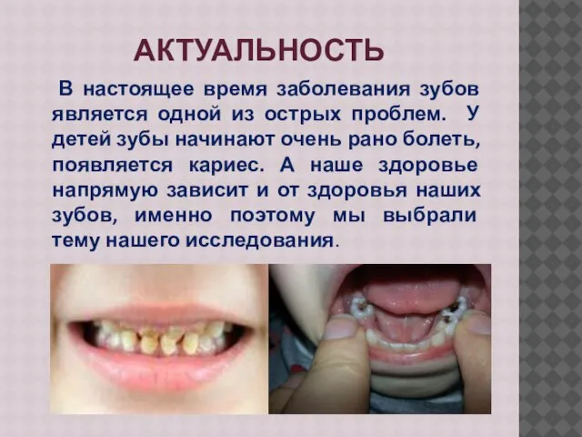 АКТУАЛЬНОСТЬ В настоящее время заболевания зубов является одной из острых проблем. У