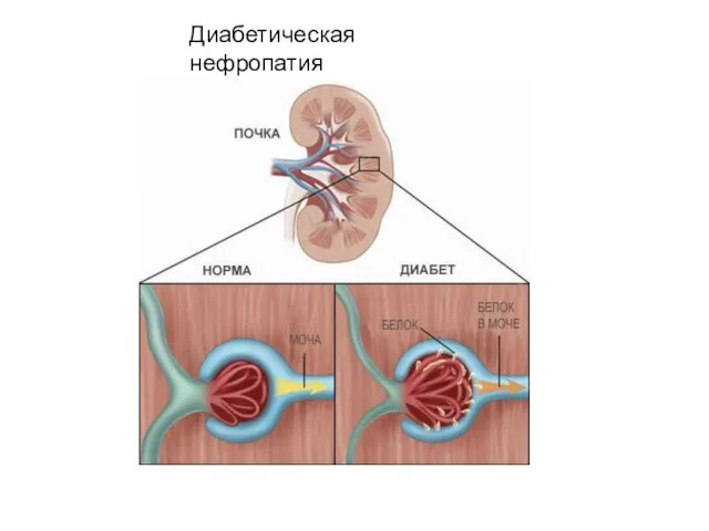 Диабетическая нефропатия