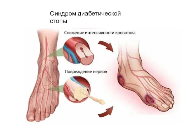 Синдром диабетической стопы