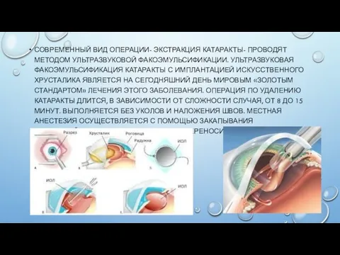 СОВРЕМЕННЫЙ ВИД ОПЕРАЦИИ- ЭКСТРАКЦИЯ КАТАРАКТЫ- ПРОВОДЯТ МЕТОДОМ УЛЬТРАЗВУКОВОЙ ФАКОЭМУЛЬСИФИКАЦИИ. УЛЬТРАЗВУКОВАЯ ФАКОЭМУЛЬСИФИКАЦИЯ КАТАРАКТЫ