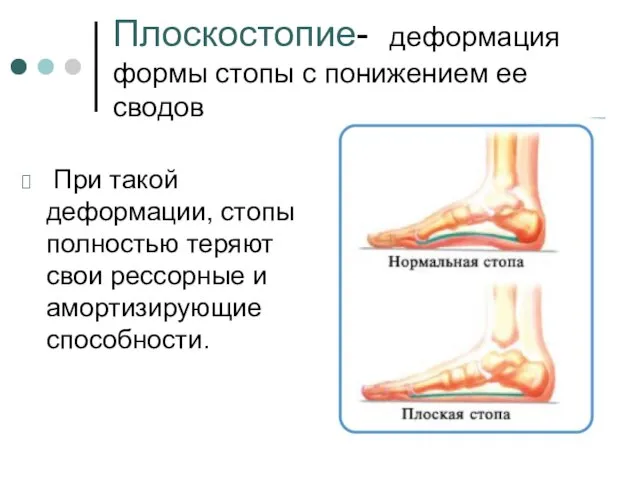 Плоскостопие- деформация формы стопы с понижением ее сводов При такой деформации, стопы