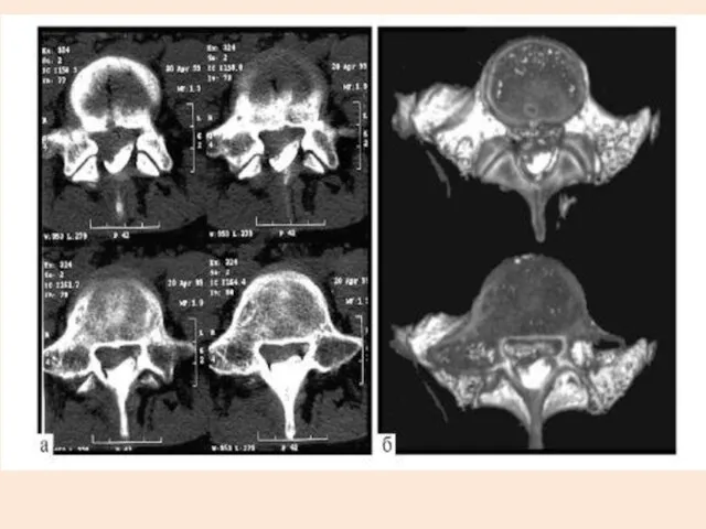 Диагностика рентгенограммы, (КТ), (МРИ) миелограмма