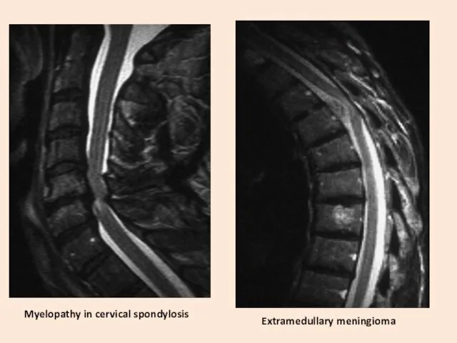 Myelopathy in cervical spondylosis Extramedullary meningioma
