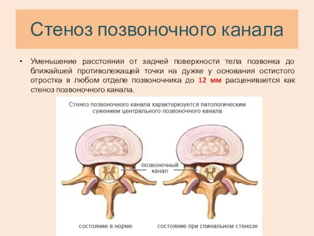 Стеноз позвоночного канала Уменьшение расстояния от задней поверхности тела позвонка до ближайшей