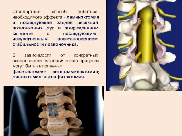 Стандартный способ добиться необходимого эффекта - ламинэктомия и последующая задняя резекция позвонковых