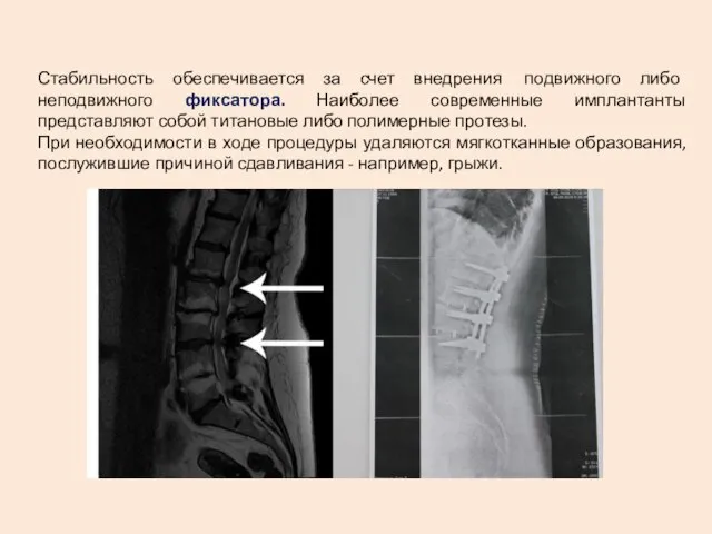 Стабильность обеспечивается за счет внедрения подвижного либо неподвижного фиксатора. Наиболее современные имплантанты