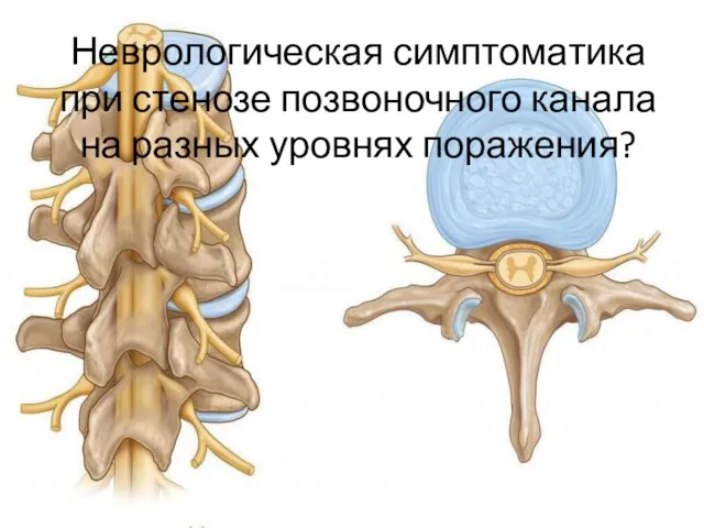 Неврологическая симптоматика при стенозе позвоночного канала на разных уровнях поражения?