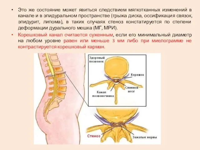 Это же состояние может явиться следствием мягкотканных изменений в канале и в