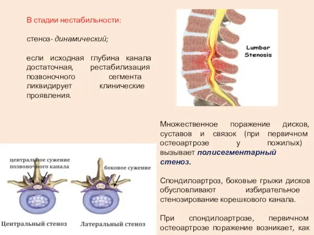 В стадии нестабильности: стеноз- динамический; если исходная глубина канала достаточная, рестабилизация позвоночного