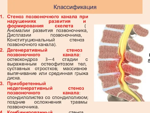 Классификация Стеноз позвоночного канала при нарушениях развития и формирования скелета ( Аномалии