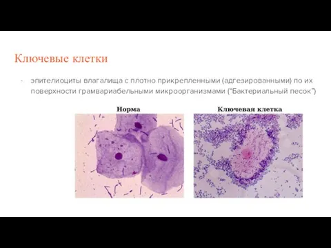 Ключевые клетки эпителиоциты влагалища с плотно прикрепленными (адгезированными) по их поверхности грамвариабельными микроорганизмами (“Бактериальный песок”)