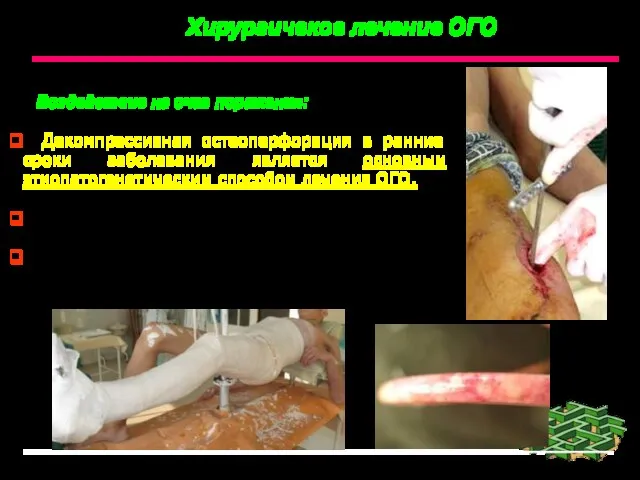 Хирургичекое лечение ОГО Воздействие на очаг поражения: Декомпрессивная остеоперфорация в ранние сроки