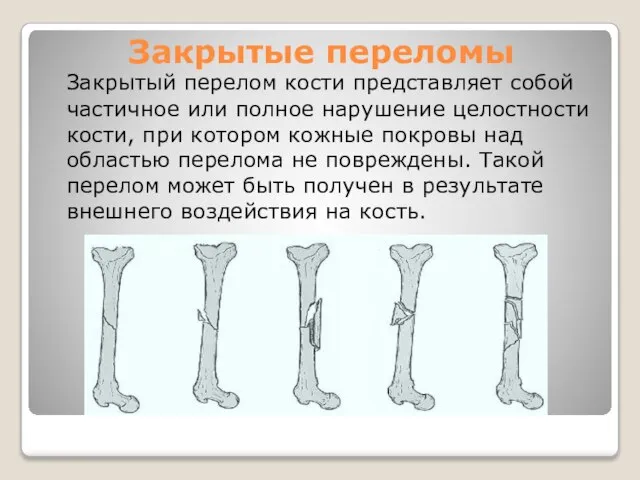 Закрытые переломы Закрытый перелом кости представляет собой частичное или полное нарушение целостности