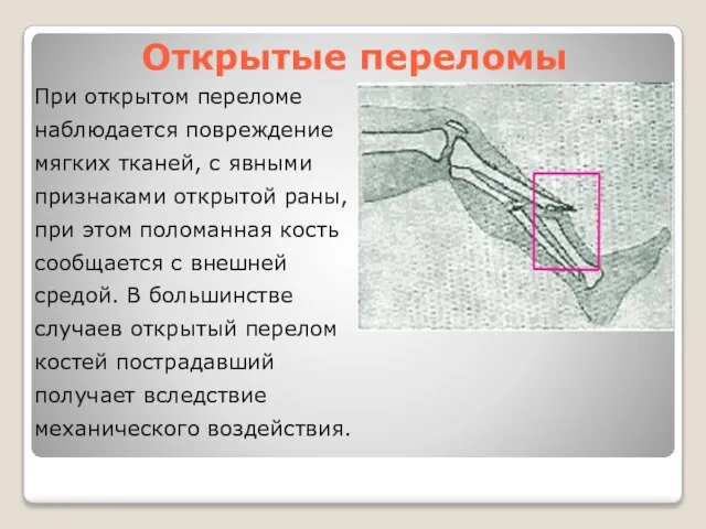 Открытые переломы При открытом переломе наблюдается повреждение мягких тканей, с явными признаками