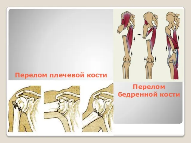 Перелом плечевой кости Перелом бедренной кости