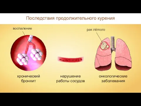 хронический бронхит нарушение работы сосудов онкологические заболевания Последствия продолжительного курения