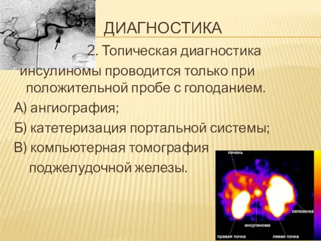 ДИАГНОСТИКА 2. Топическая диагностика инсулиномы проводится только при положительной пробе с голоданием.