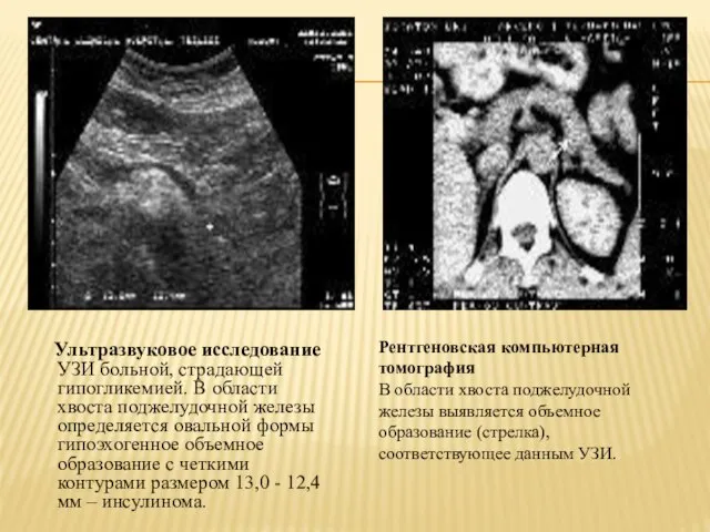 Ультразвуковое исследование УЗИ больной, страдающей гипогликемией. В области хвоста поджелудочной железы определяется