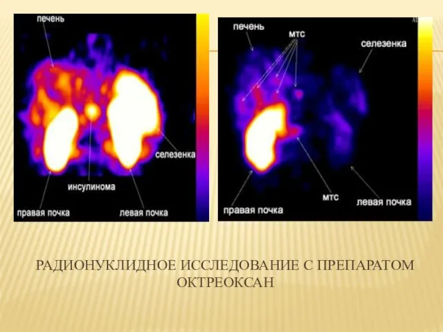 РАДИОНУКЛИДНОЕ ИССЛЕДОВАНИЕ С ПРЕПАРАТОМ ОКТРЕОКСАН