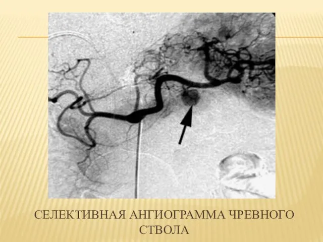 СЕЛЕКТИВНАЯ АНГИОГРАММА ЧРЕВНОГО СТВОЛА