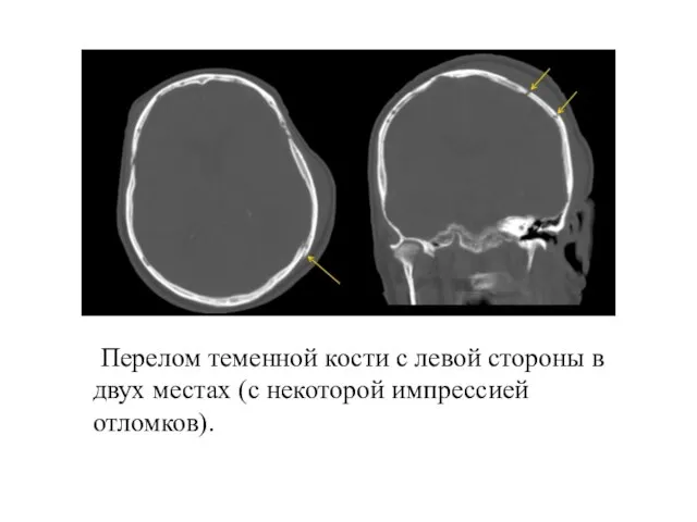 Перелом теменной кости с левой стороны в двух местах (с некоторой импрессией отломков).