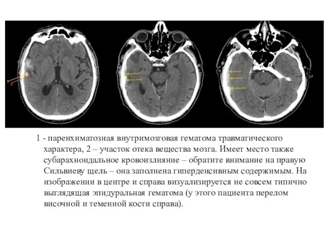 1 - паренхиматозная внутримозговая гематома травматического характера, 2 – участок отека вещества