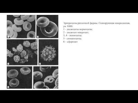 Эритроциты различной формы. Сканирующая микроскопия, ув. 8000: 1 - дискоциты-нормоциты; 2 -